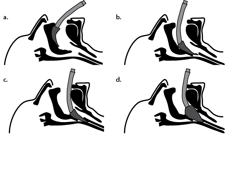 Tricks For Lma Insertion The Airway Jedi Technique Potential Problems